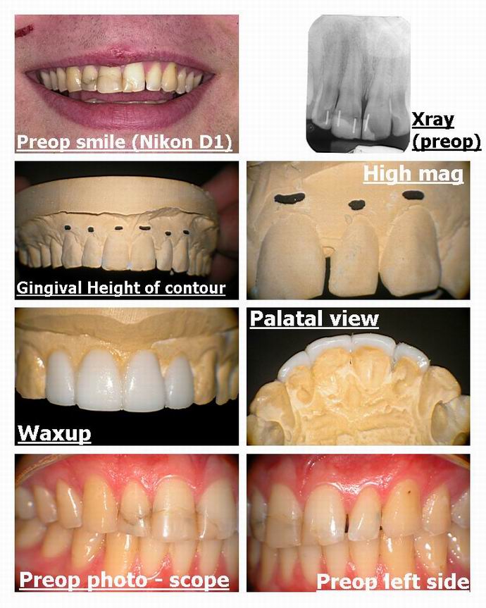 Resize of Laser recontouring with erbium pg 1.jpg